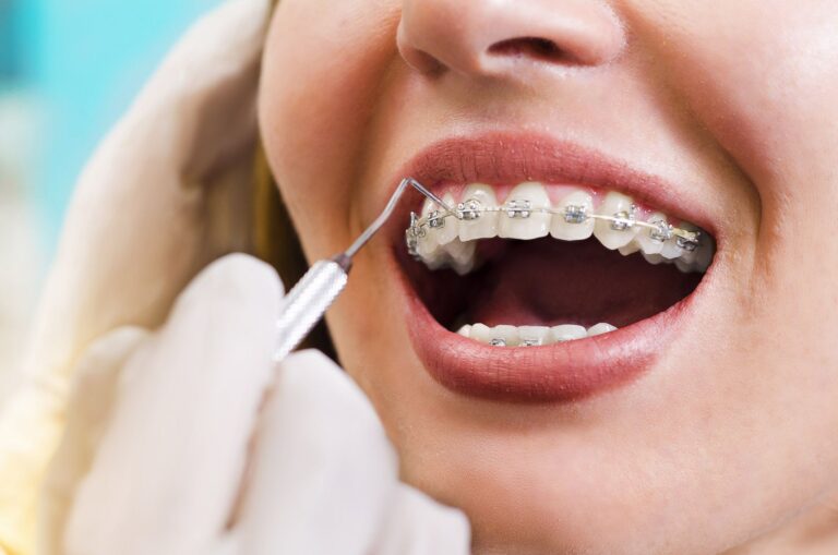 Braces vs Invisible Braces – What is the Difference?